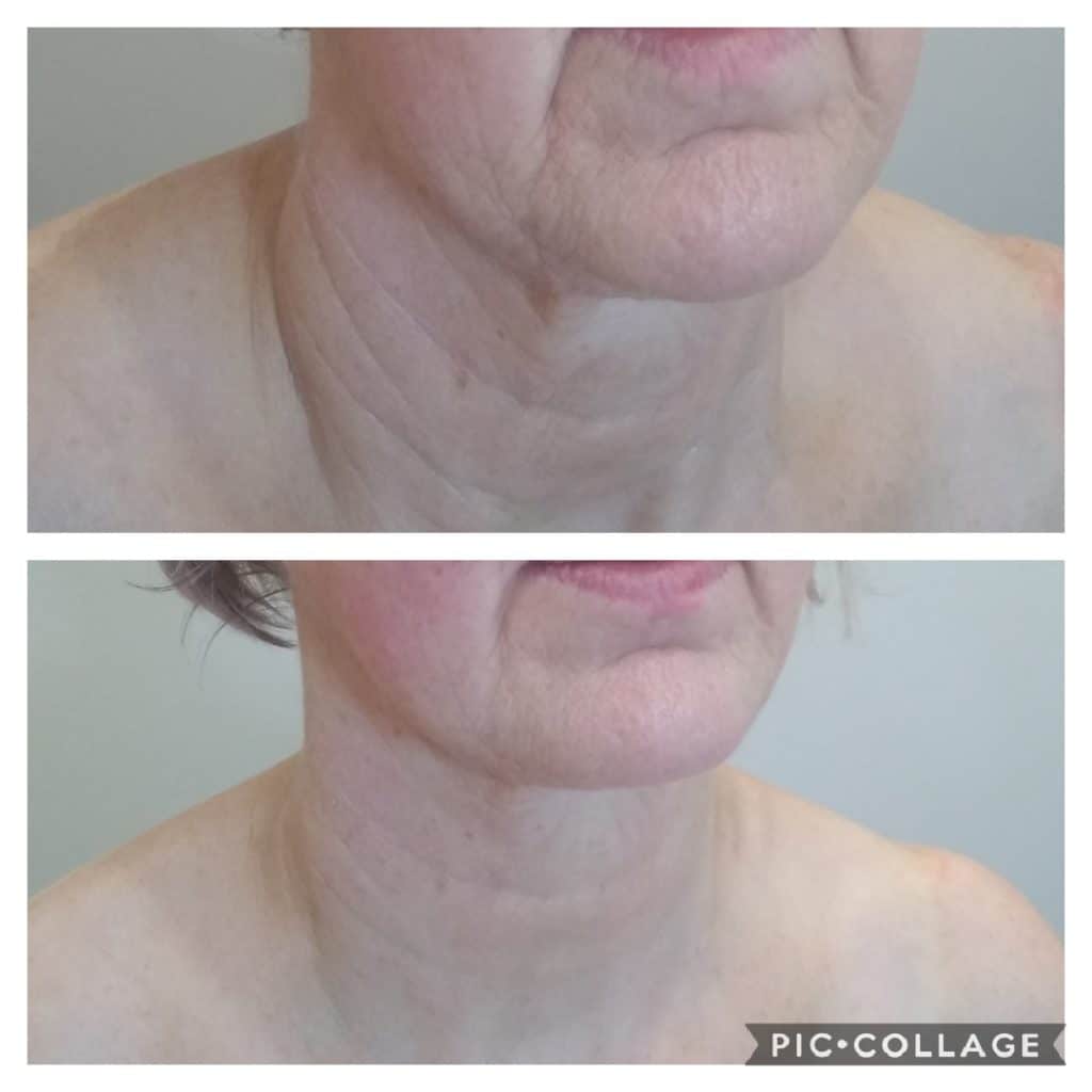 Before And After Treatments