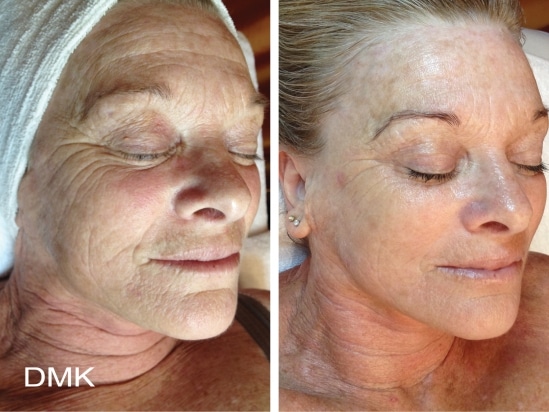 Before And After Treatments