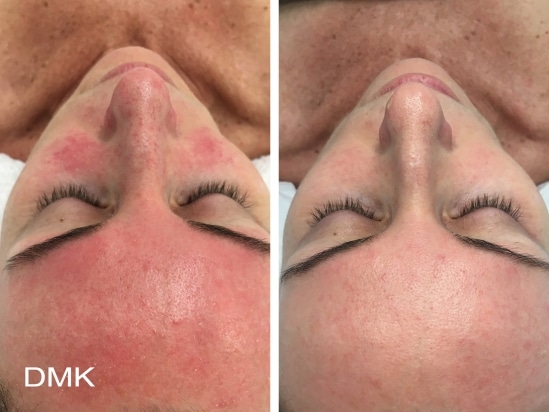 Before And After Treatments