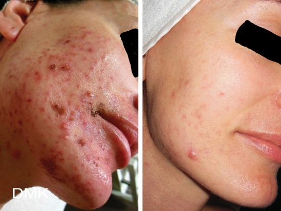 Before And After Treatments